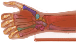 Hand Skeleton, Brown University Health Cobre research